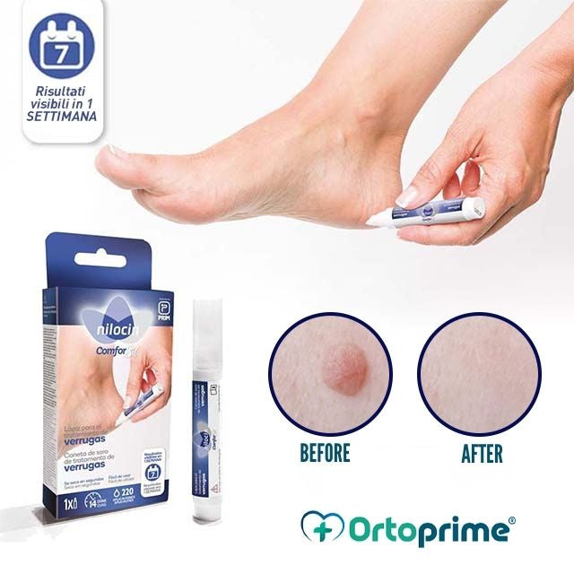 precise_application_wart_remover_stick_ortoprime-uk